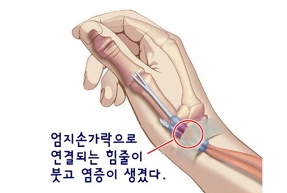 손목건초염의 원인, 증상 및 치료법 정형석한의원