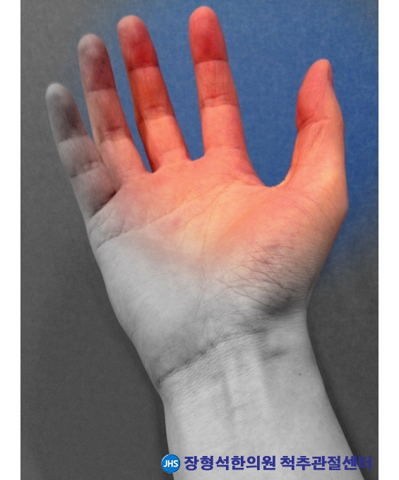 손목터널증후군의 원인, 증상 및 치료법 정형석한의원