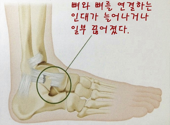 발목인대손상, 발목염좌의 원인, 증상 및 치료법 정형석한의원